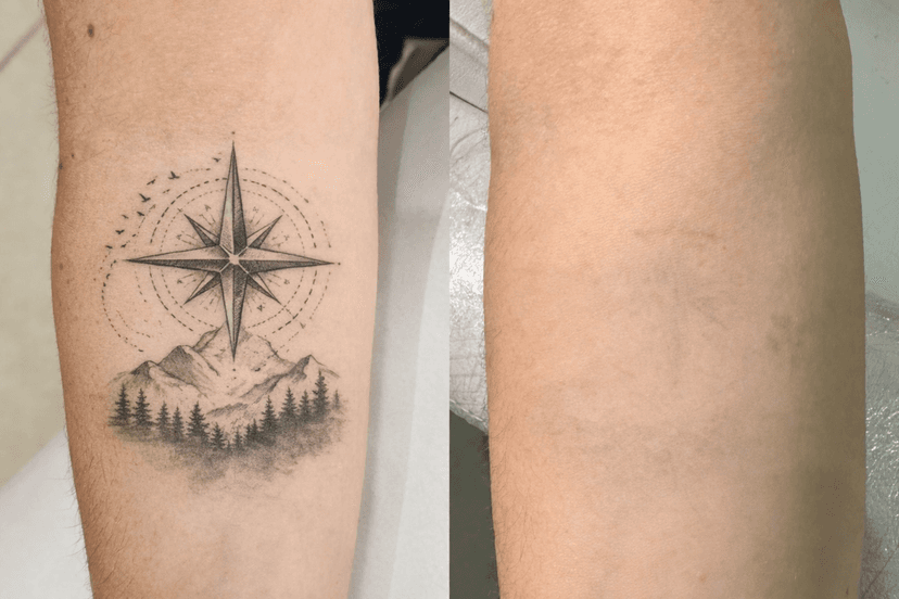 Eliminación Tatuajes (ND YAG)